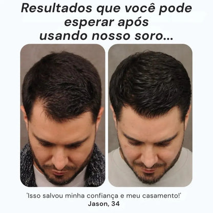 Daynava™ Roll-On para o Crescimento do Cabelo